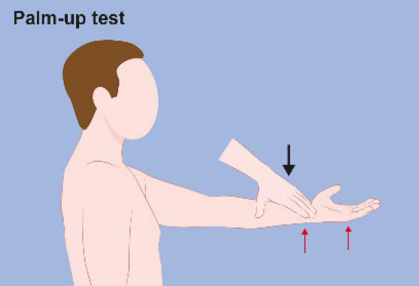 Figure 10. Palm-up test