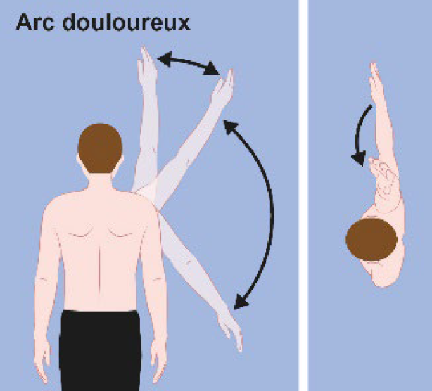 Test actif.&nbsp;Le patient doit réaliser une abduction (dans le plan frontal). La douleur apparaît généralement entre 60 et 120° d’abduction.