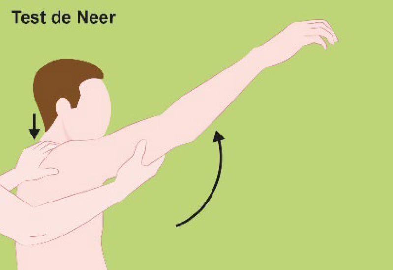 Figure 5. Test de Neer