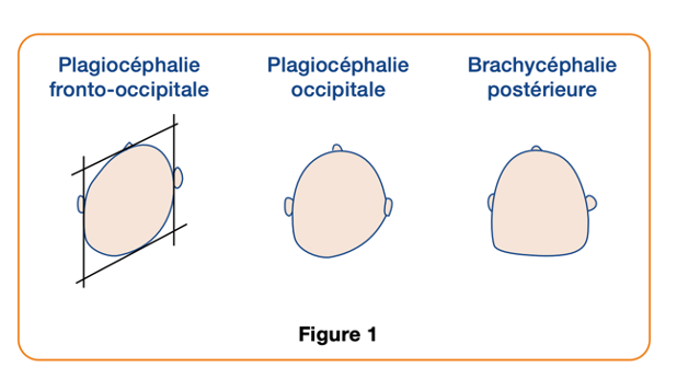 Figure 1. Formes typiques de d&eacute;formation cr&acirc;nienne positionnelle (DCP).