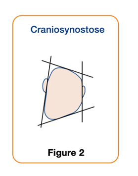 Figure 2. Craniosynostose (diagnostic diff&eacute;rentiel)