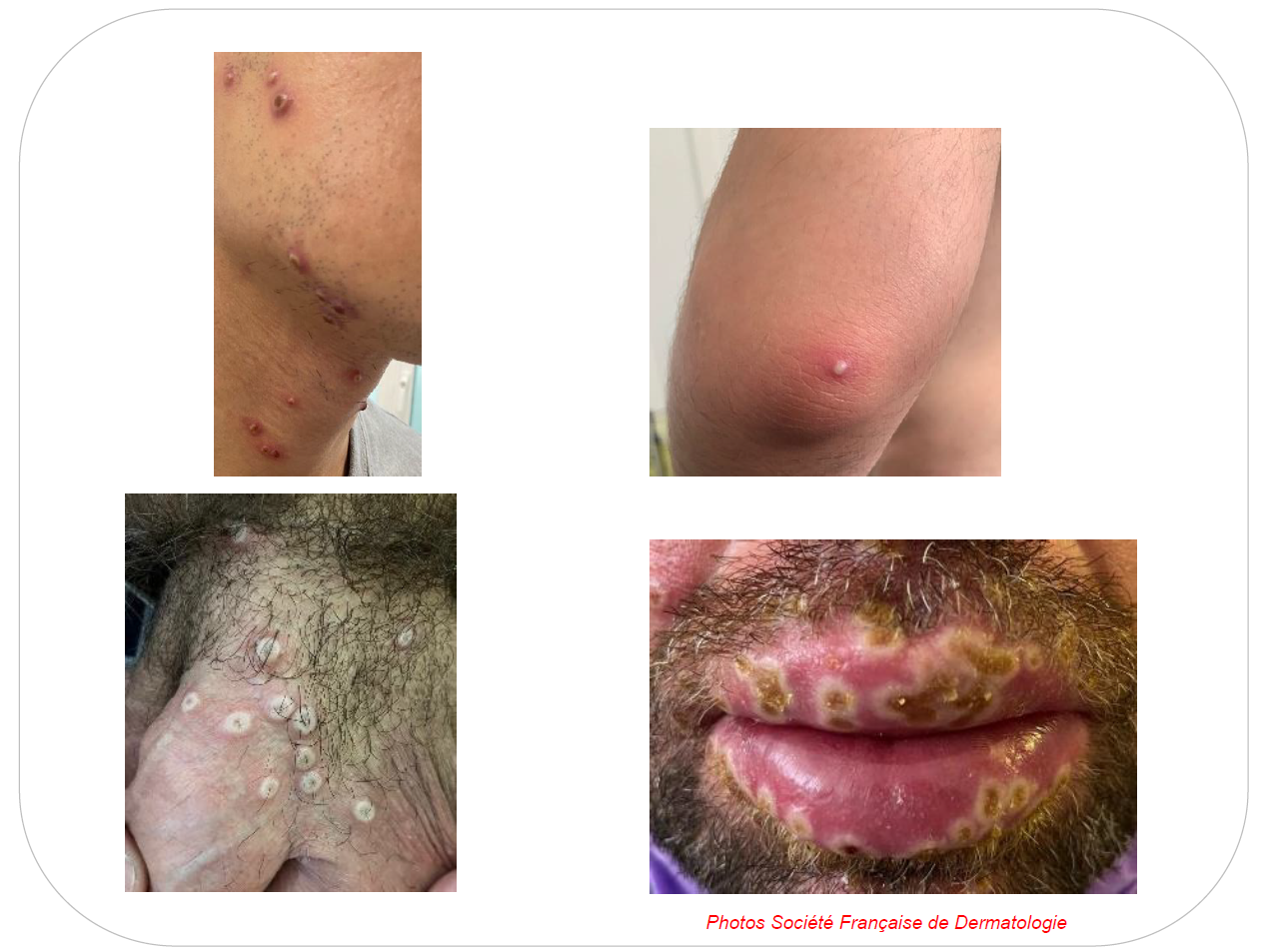 Figure 2. Lésions cutaneomuqueuses d'une infection par le Monkeypox